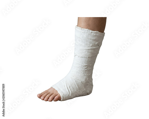 Medical plaster cast on injured foot and ankle, white orthopedic fiberglass bandage for bone fracture, patient leg with surgical dressing for recovery isolated on Transparent Background