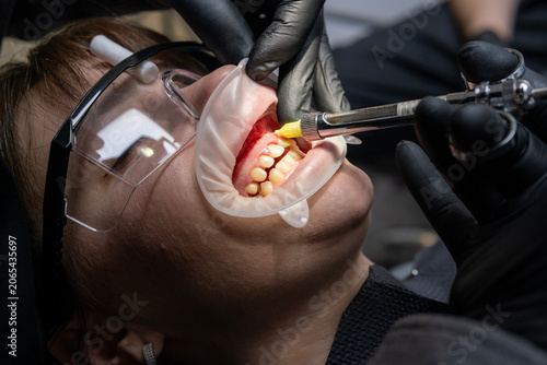 Fotografie Dentist administering painless local anesthesia to a patient with a mouth retrac
