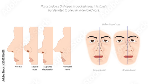 Obraz na plátně Nasal Deformities- Crooked Nose, Deviated Nose and Saddle Nose, common external nasal deformities, including crooked nose, deviated nose, saddle nose, supratip depression, and hump nose