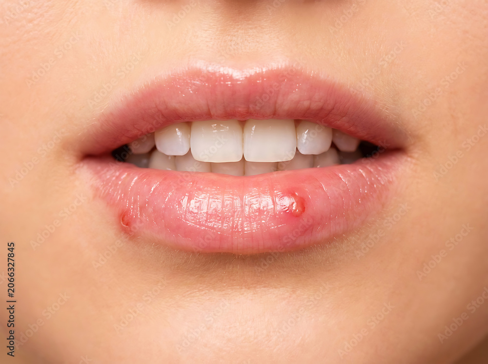 Naklejka premium Close up of woman's lips with cold sores and white teeth mouth pink