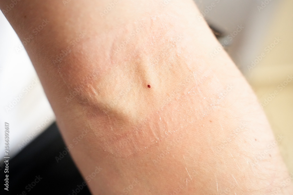 Naklejka premium Close-up of an injection mark and medical plaster trace on the inner elbow skin