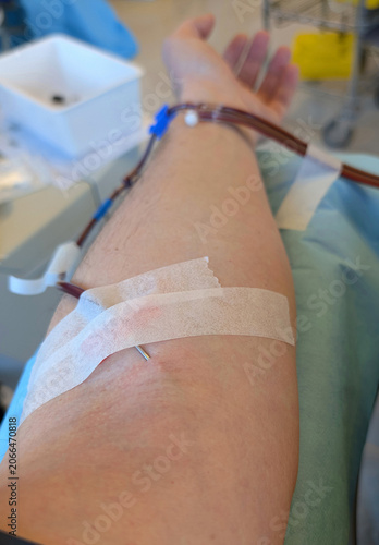 Obraz na plátně Close up of a mans arm during a blood donation with needle and tubes