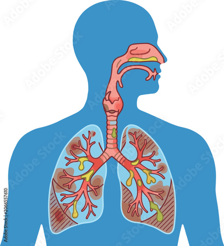 Billede på lærred Medical infographic vector illustration of diseased human respiratory system sho