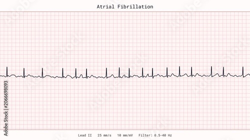 Atrial Fibrillation AFib Irregular Heartbeat ECG EKG Monitor 4K Medical Video Arrhythmia Cardiology Clinic Vital Signs Patient Tracing Healthcare Heart Disease Stroke Risk Palpitation Animation