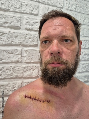 surgical suture on a man's shoulder.