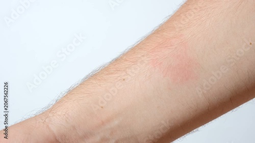 Close-up of a red allergic rash and skin irritation on a patient hand