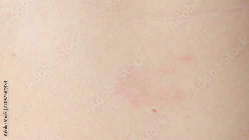 Detailed macro shot of dermatitis spots and redness on sensitive skin