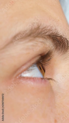 Keratoconus eye disease, cornea thinning and cone shaped eye distortion