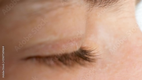 Advanced keratoconus eye disease macro profile view