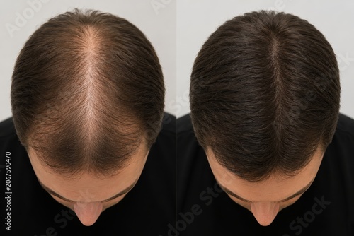 Before and after comparison of a bald man suffering from hair loss and a man with restored hair density. Trichology treatment result, hair transplantation, alopecia recovery concept.