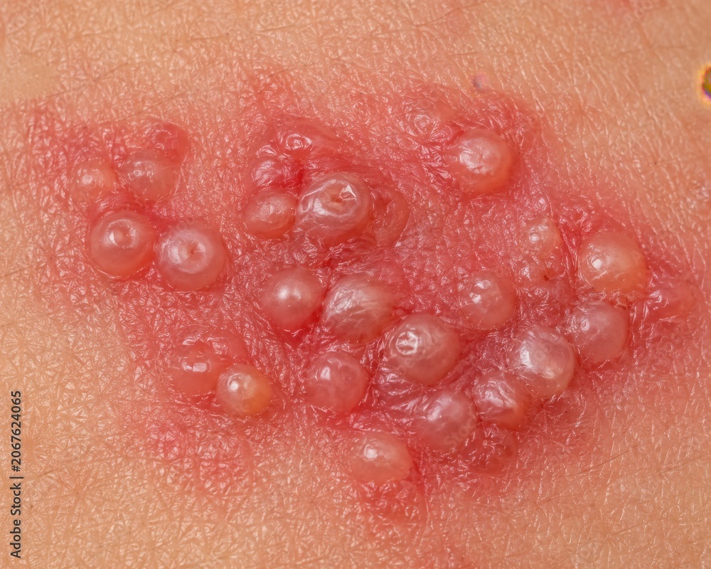 Fototapeta premium Extreme Macro Close-Up of Herpes Zoster Shingles Vesicles Showing Fluid-Filled Blisters Clustered on Inflamed Red Skin Surface