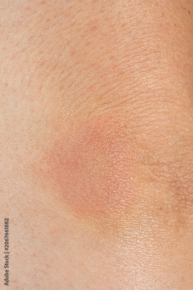 Fototapeta premium Erythema migrans rash caused by Lyme disease. Borreliosis symptom