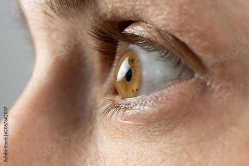 Conical cornea deformity in severe keratoconus patient
