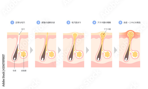 ニキビができる仕組みと毛穴詰まりの過程を示した肌断面図イラスト