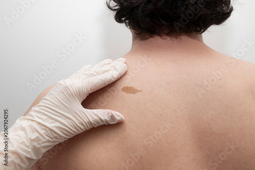 Doctor examining a birthmark on the upper back of an adult man during a skin checkup. Concept of dermatology, skin cancer prevention, medical examination, early diagnosis, healthcare.