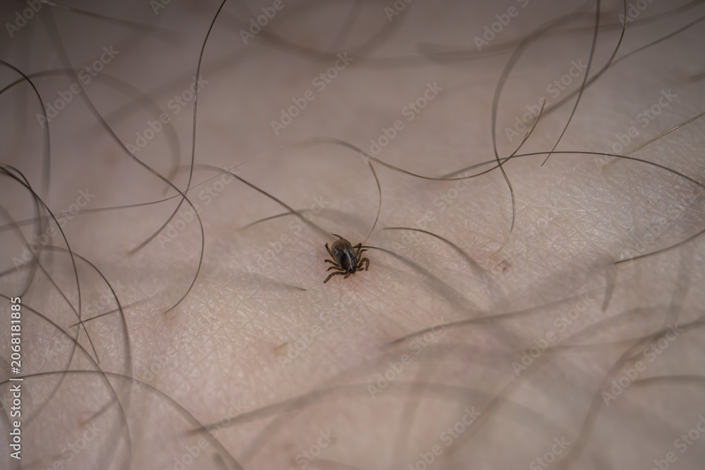 Ταπετσαρία Extreme macro photograph showing a tick attached to human skin among body hair