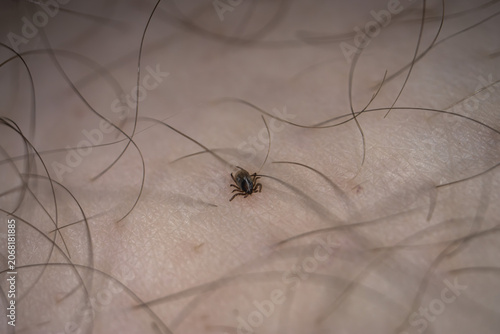 Tableau sur toile Extreme macro photograph showing a tick attached to human skin among body hair