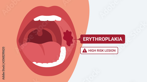 Obraz na płótnie Erythroplakia High Risk Oral Mucosal Lesion