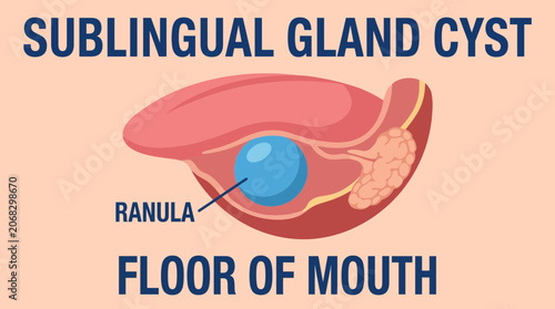 Schilderij op canvas Ranula Sublingual Gland Cyst Floor Mouth
