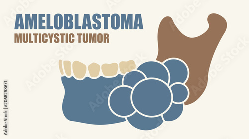 Obraz na płótnie Ameloblastoma Jaw Tumor Multicystic Appearance