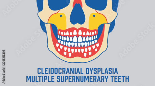 Cuadro en lienzo Cleidocranial Dysplasia Multiple Supernumerary Teeth