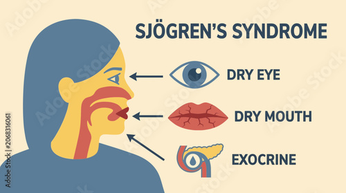 Fotografía Sjögren's Syndrome Dry Eye Mouth Exocrine