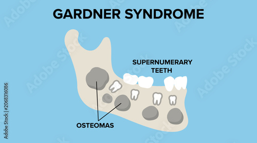 Vászonkép Gardner Syndrome Jaw Osteomas Supernumerary Teeth