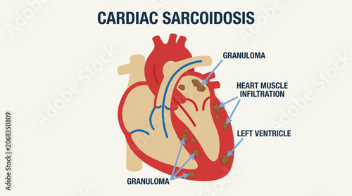 Foto Cardiac Sarcoidosis Granuloma Heart Muscle Infiltration Diagram