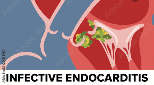 Fotografía Infective Endocarditis Microbial Growth Heart Valve Vegetation