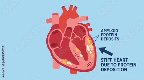 Fotografie Amyloid Cardiomyopathy Protein Deposition Stiff Heart Illustration