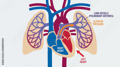 Bild auf Leinwand Pulmonary Hypertension Elevated Pressure Lung Vessels Diagram