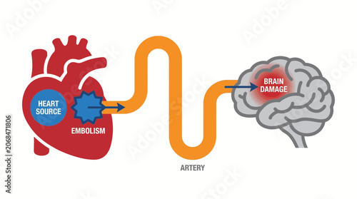 Cardioembolic Stroke Heart Source Embolism Brain Damage Diagram