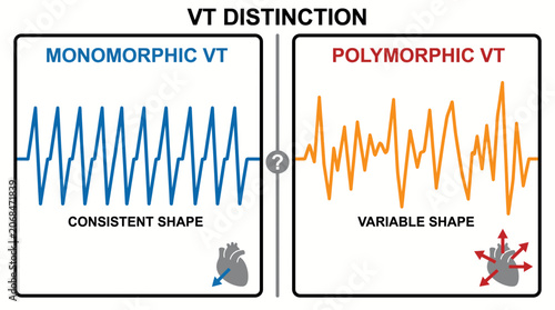Bild auf Leinwand Ventricular Tachycardia Monomorphic Polymorphic Distinction Diagram