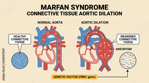 Obraz na płótnie Marfan Syndrome Connective Tissue Aortic Dilation Diagram