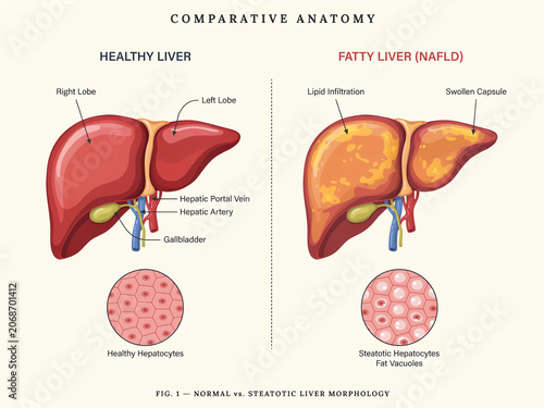 Healthy Liver and Fatty Liver Comparison Medical Diagram