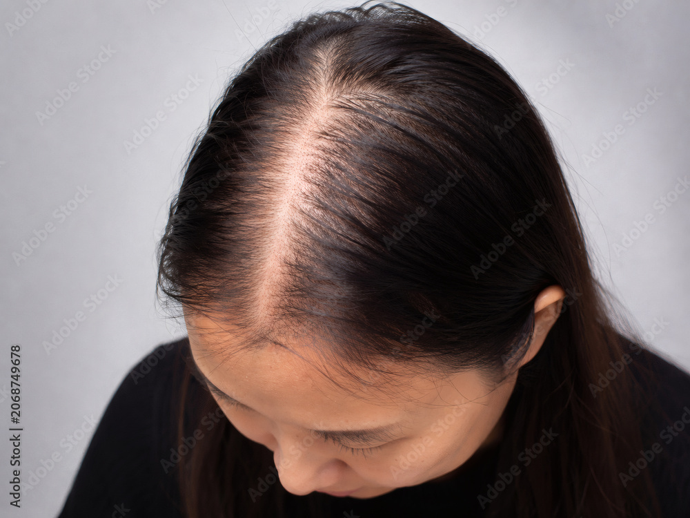 Fototapeta premium Female Pattern Hair Loss Viewed at 45 Degree Angle with Visible Scalp Thinning