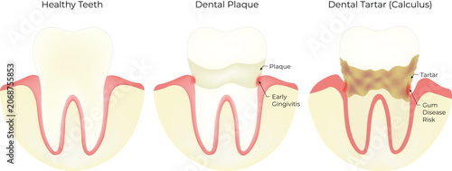 Dental Plaque, Tartar, and Healthy Teeth Comparison Illustration