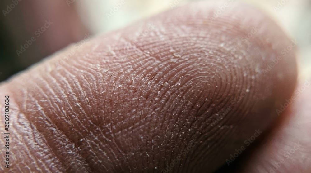 Fototapeta premium Extreme Closeup of Dry Cracked Finger Skin with Visible Fingerprints.