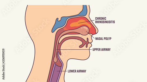 Foto Chronic Rhinosinusitis Nasal Polyp Extending into Lower Airway