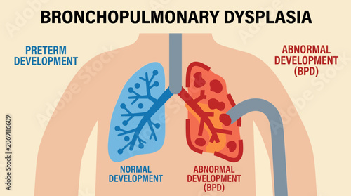 Foto Bronchopulmonary Dysplasia Abnormal Lung Development in Preterm