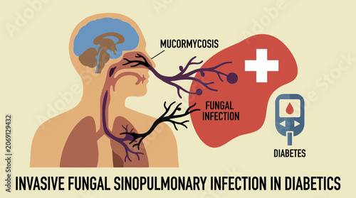 Photos Mucormycosis Invasive Fungal Sinopulmonary Infection in Diabetics