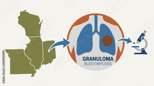 Pulmonary Blastomycosis Fungal Granuloma in Midwest Region