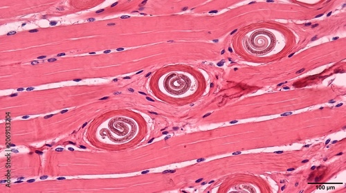 Microscopic view of Trichinella spiralis larvae encysted within muscle tissue.