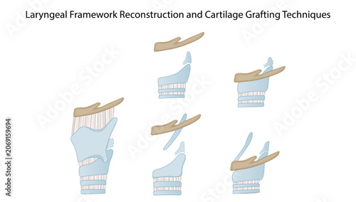 Foto Laryngeal Framework Reconstruction and Cartilage Grafting Techniques, demonstrat