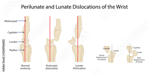 Fotografie Perilunate and Lunate Dislocations of the Wrist,normal wrist alignment with perilunate and lunate dislocations, highlighting characteristic carpal bone displacement patterns