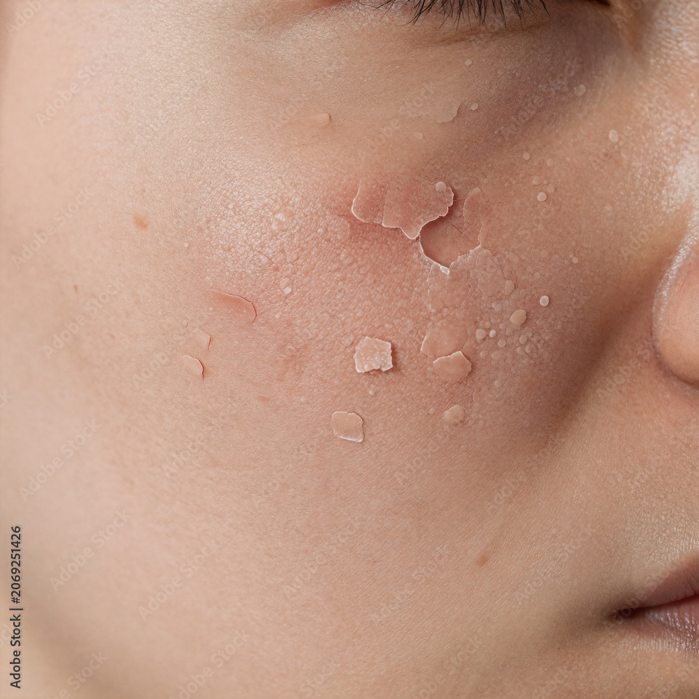 Fototapeta premium Cartoon Texture Unhealthy. Close-Up Of Unhealthy Human Skin Epidermis With Flaky And Cracked Texture