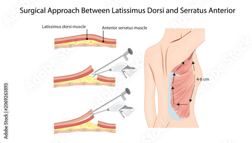Foto Surgical Approach Between Latissimus Dorsi and Serratus Anterior, demonstrating the surgical plane between the latissimus dorsi and serratus anterior muscles for thoracic and scapular surgical