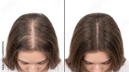 Before and after hair restoration, female pattern hair loss improvement, hair growth transformation, scalp treatment results, visible hair thickening progress, hair regrowth success, beauty care