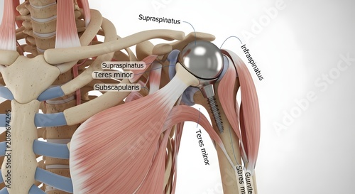 Anatomical illustration of human shoulder with prosthetic joint replacement