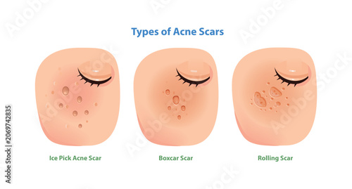 Foto Types of Acne Scars Illustration Ice Pick, Boxcar and Rolling Scars